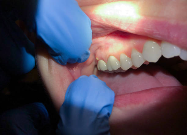 Best Emergency Root Canal Treatment in Burgaw, NC